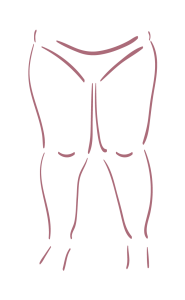 lipedema grado 2