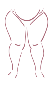 lipedema grado 3