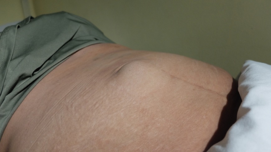 hernia discal o ciatica