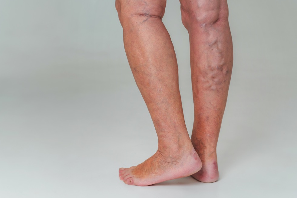 pierna varices