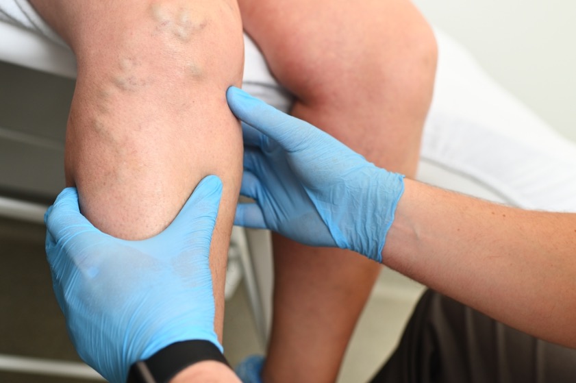 Linfedema en piernas: Cómo prevenir y diferenciar de lipedema