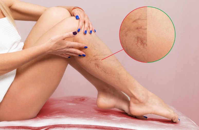Causas y problemas de tener venas varicosas
