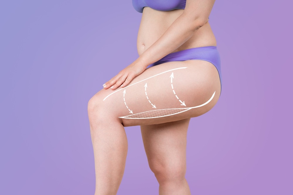 Acumulación de grasa en las piernas: Causas y tratamientos para reducirla