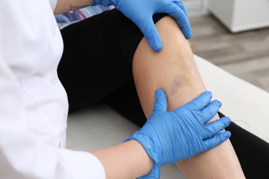 ¿El lipedema puede causar hematoma en piernas?