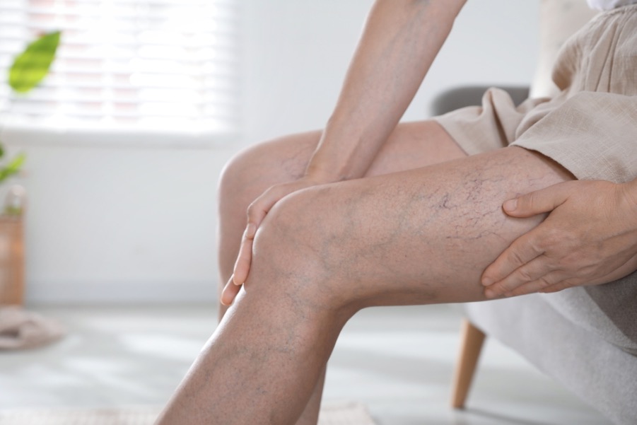porque salen las varices