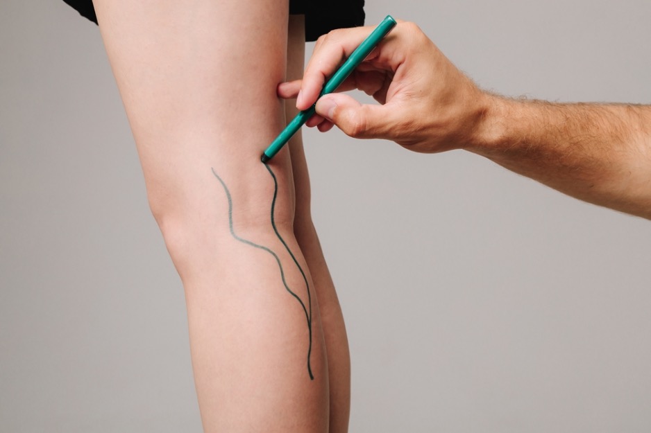 cirujano vascular lipedema