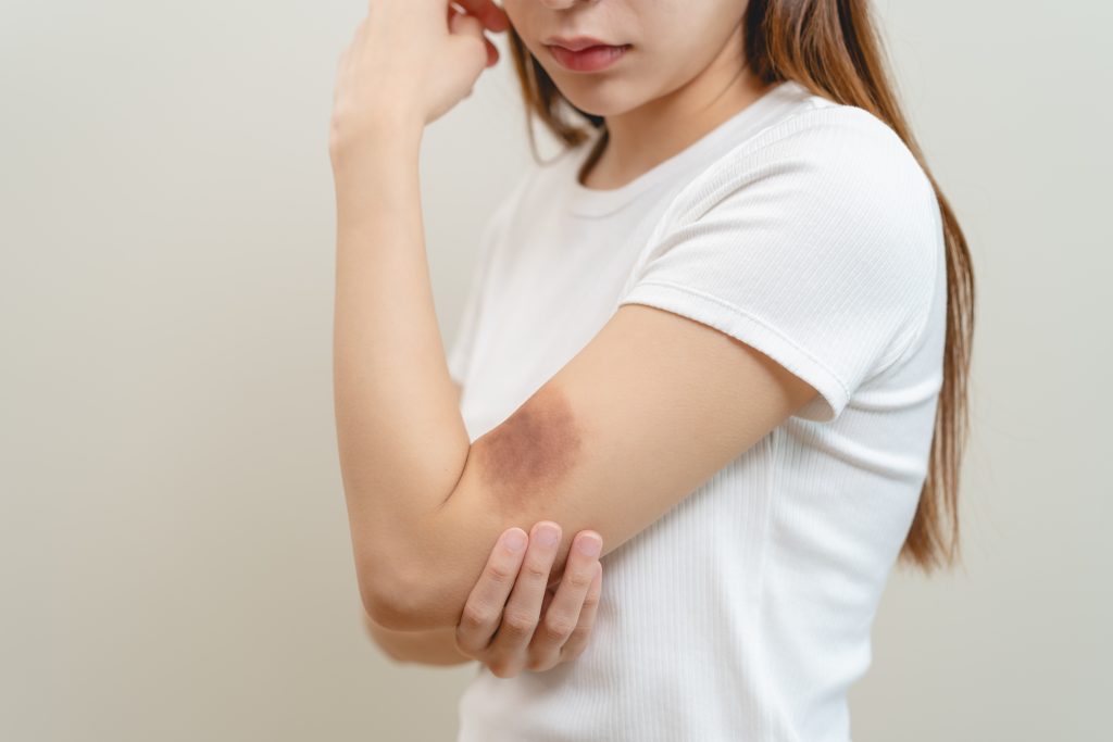 fragilidad capilar en las manos