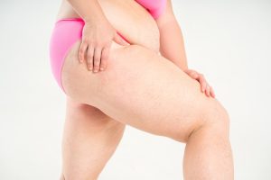 como es la operacion de lipedema