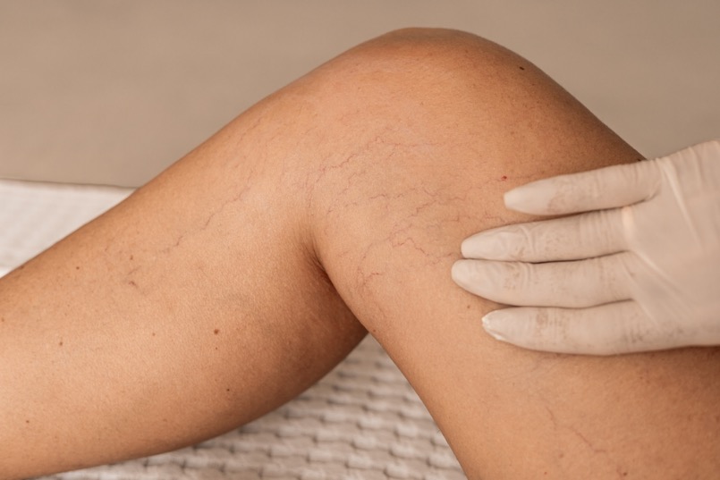operacion lipedema piernas