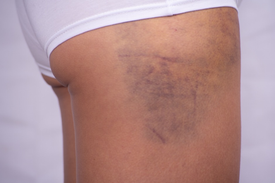 bultos en las piernas por mala circulación