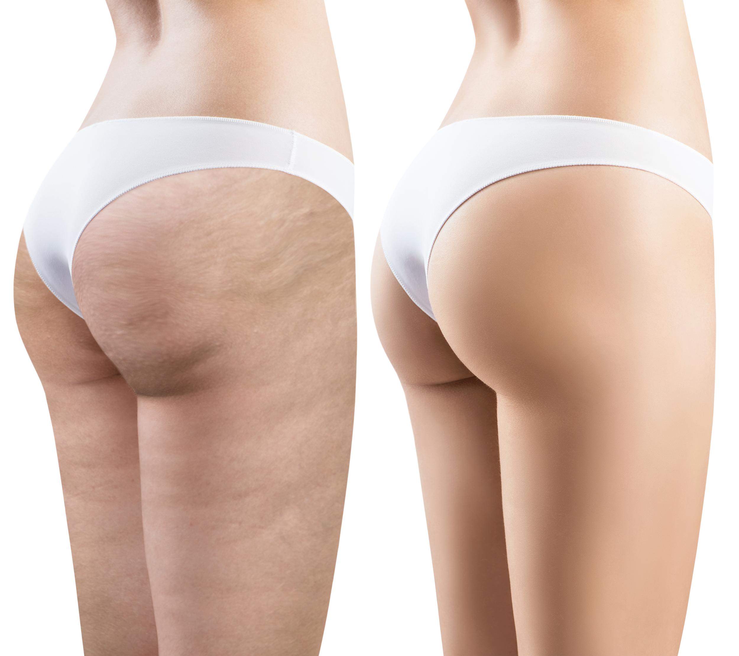 Descubre la Diferencia entre lipedema y celulitis! - Clinica Simarro