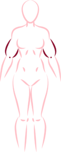 tipo de lipedema 04a