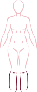 tipo de lipedema 04b 1