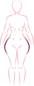 tipo de lipedema 1