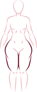 tipo de lipedema 2